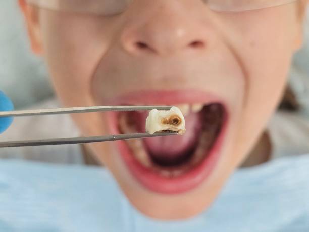 Best Emergency Root Canal Treatment in Brushy, OK